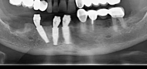 Dental Implants image 6