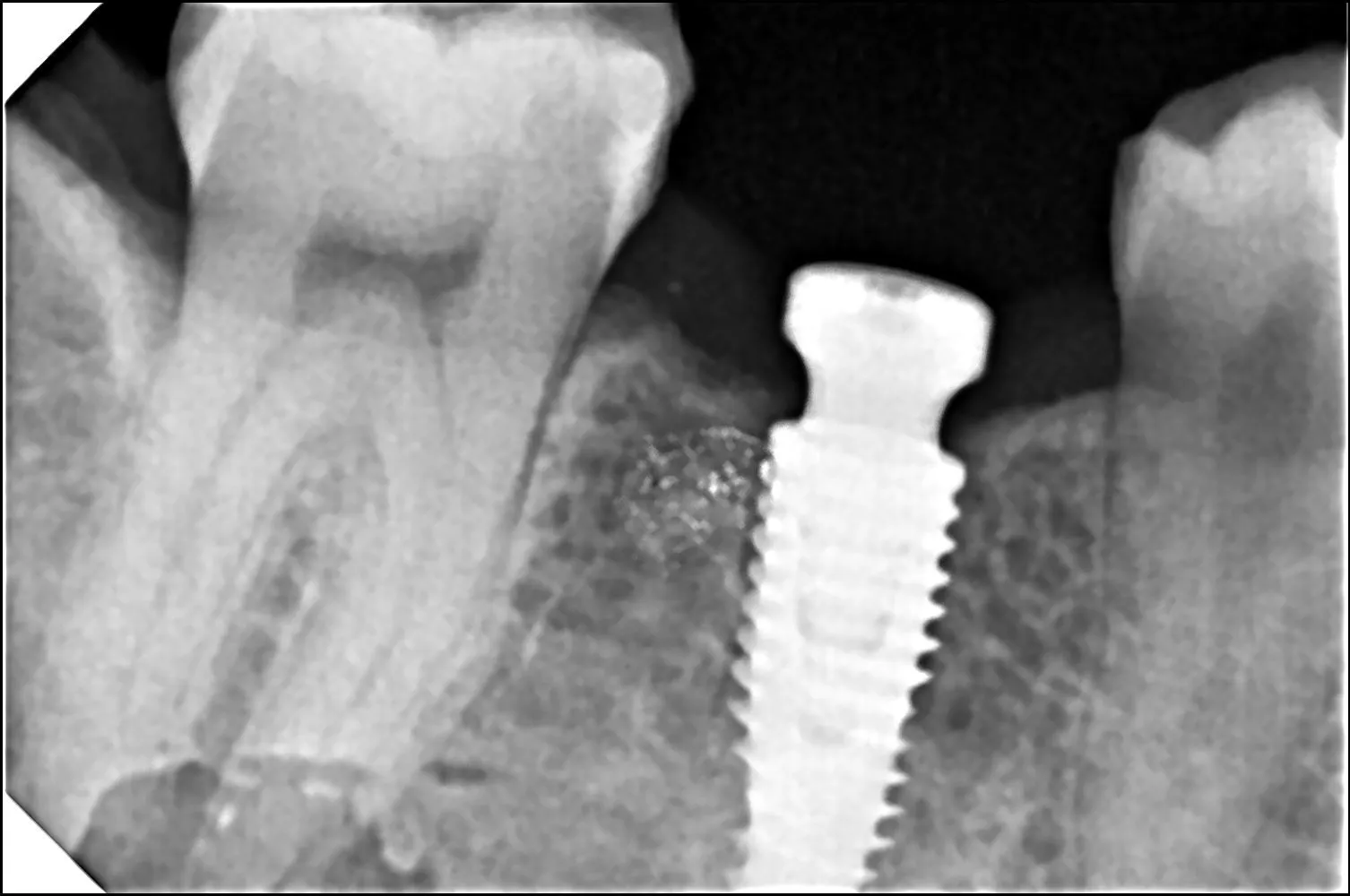 Dental Implants image 3