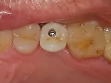 Dental Implants image 8