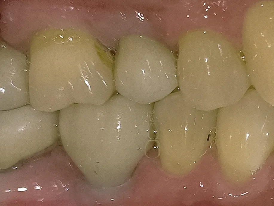Dental Implants image 7