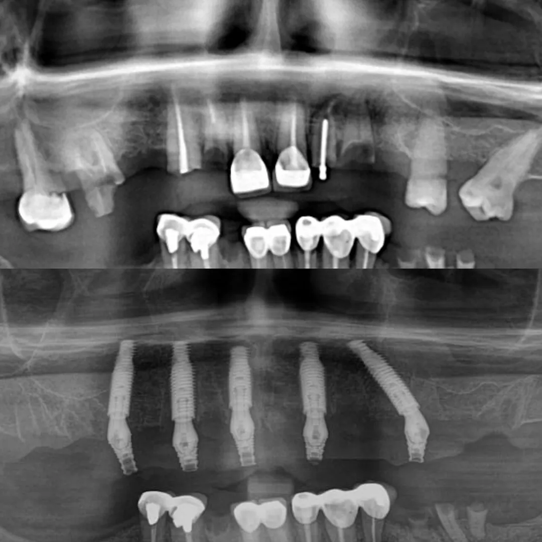 Dental Implants image 9