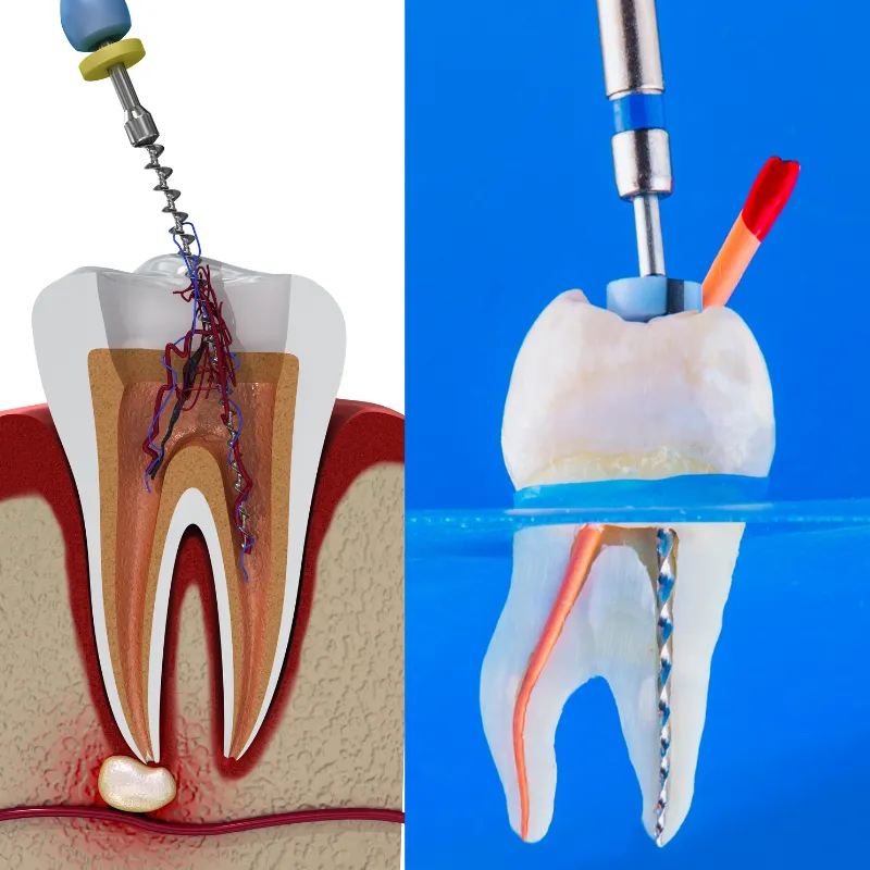 Root Canal image 1