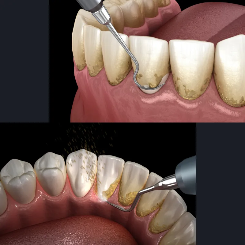 Teeth Cleaning image 1
