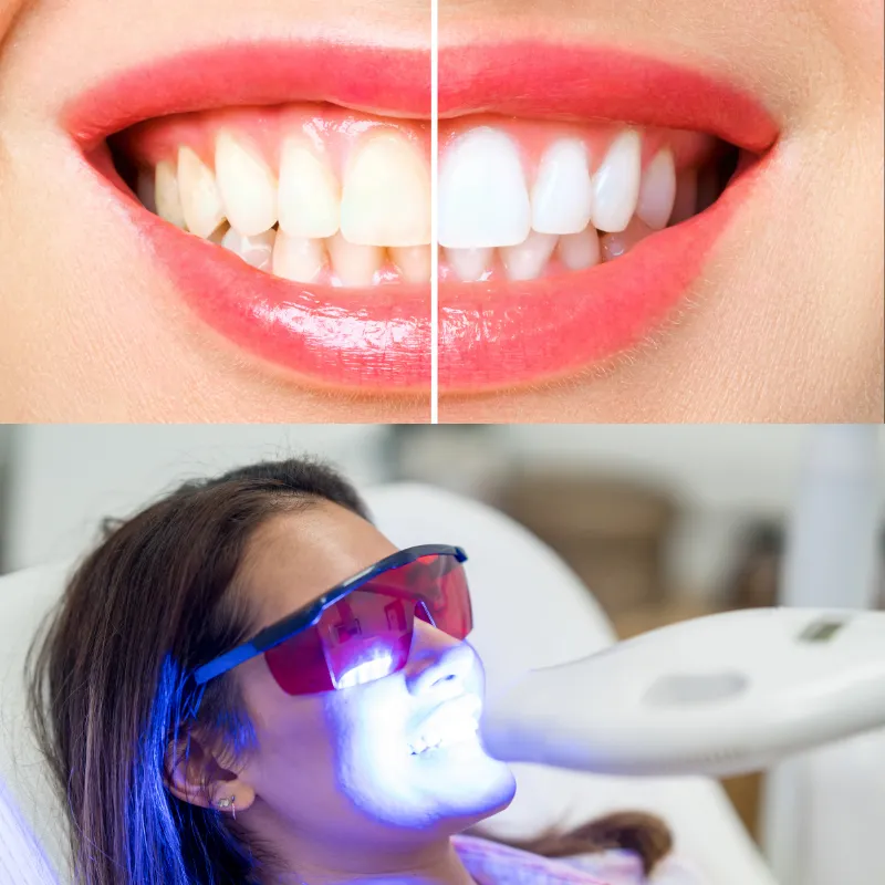 Teeth Whitening image 1