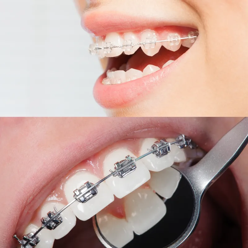 Braces image 1