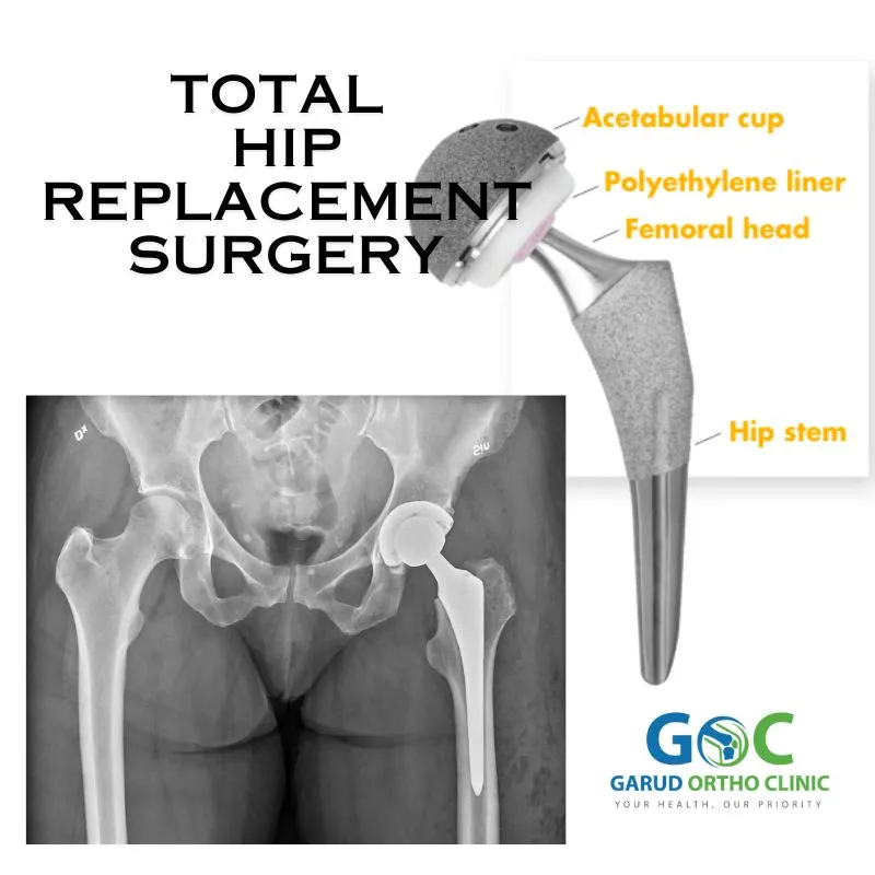 Total Hip Replacement image 1
