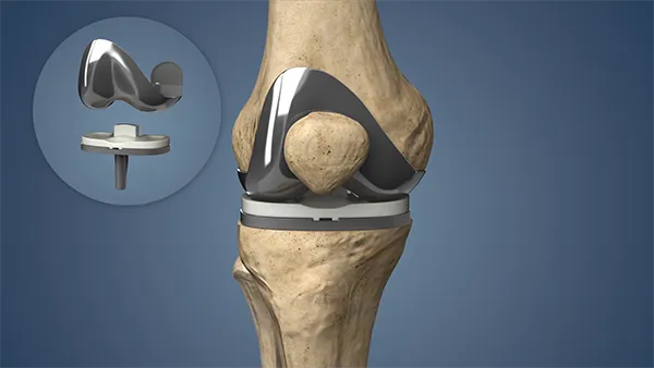 Total Knee Replacement image 1