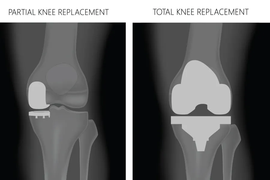 Partial Knee replacement Surgery image 1