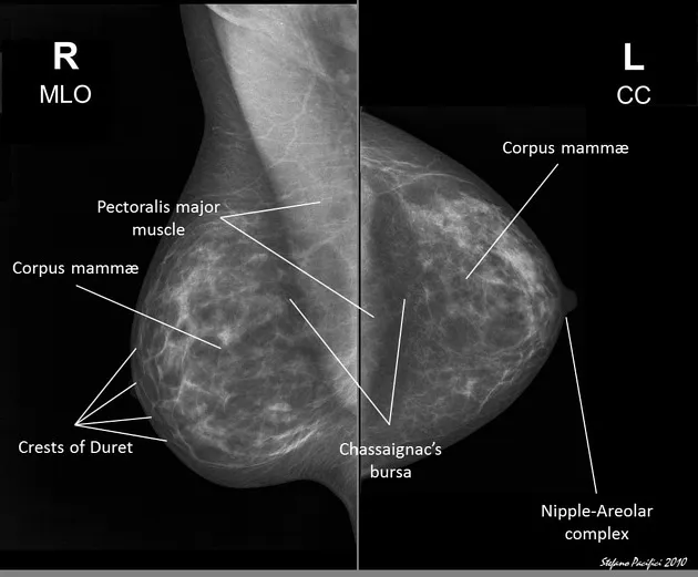 MAMMOGRAMS image 1