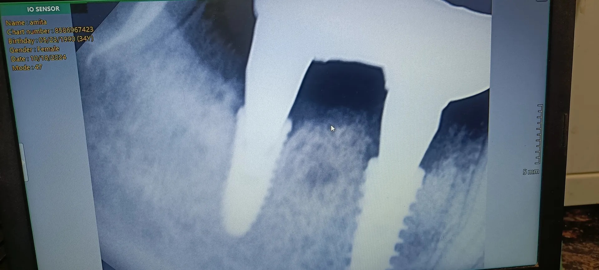 Dental Implants image 1