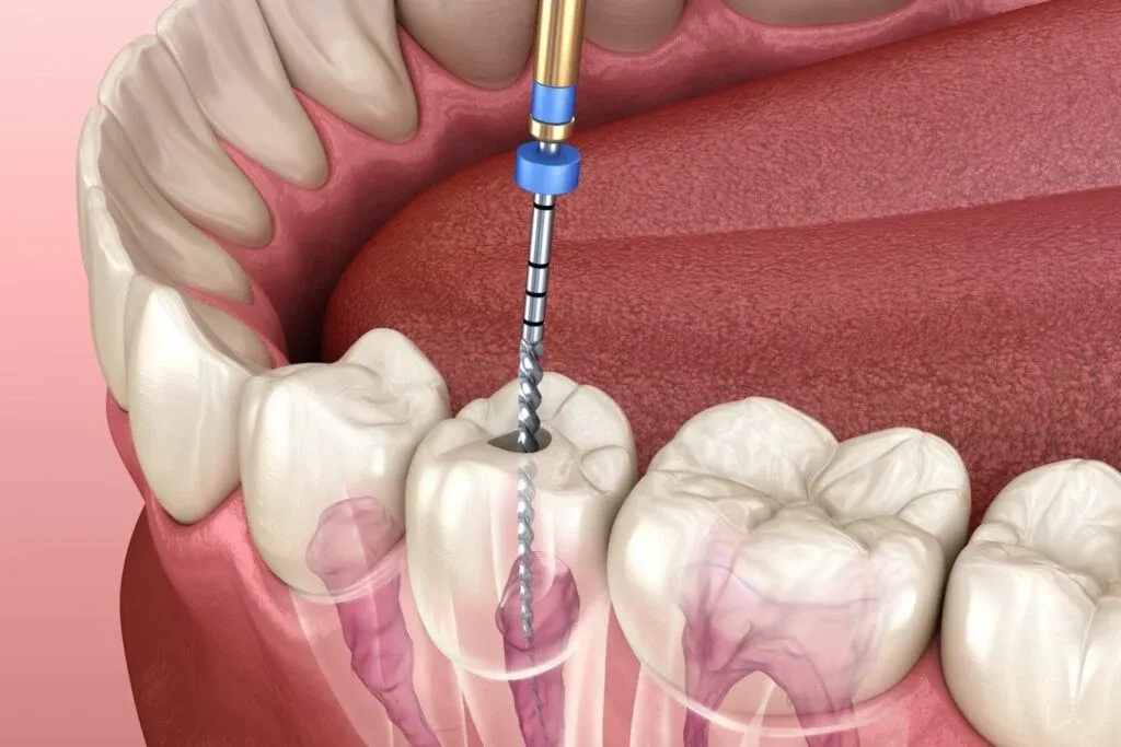 Root Canal Treatment image 1