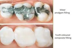 Dental Filling image 1
