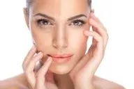 Laser Pigmentation Treatment image 1