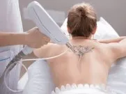 Laser Tattoo Removal Treatment image 1