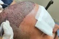 FUE Hair Transplant image 1