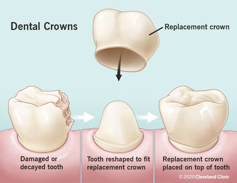 CAP PLACEMENT image 1