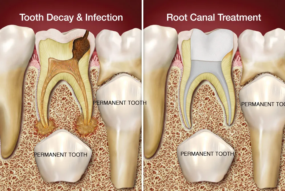 KIDS FILLINGS AND ROOT CANAL TREATMENT AND CAP PLACEMENT image 1
