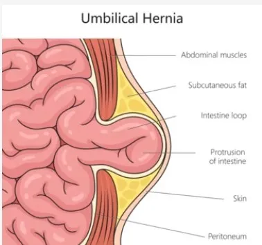 Robotic Umbilical hernia repair image 1