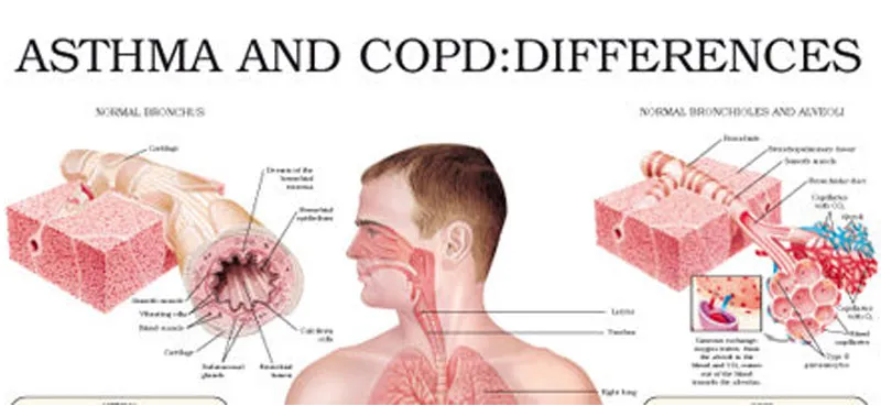 Asthma and COPD image 1