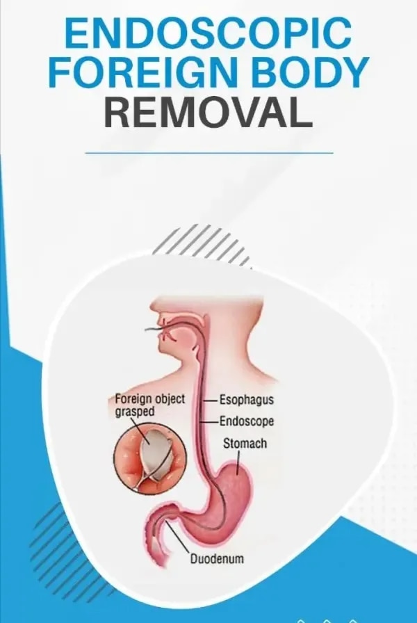 Endoscopic Foreign Body Removal image 1