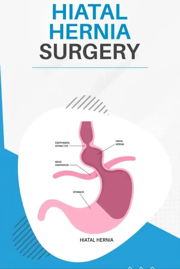 Hiatal Hernia Surgery image 1