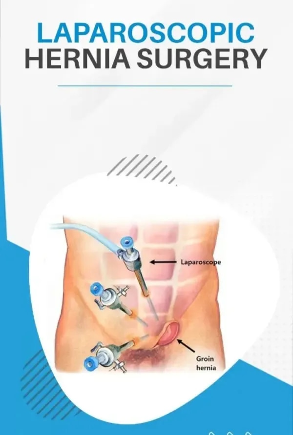 Laparoscopic Hernia Surgery image 1