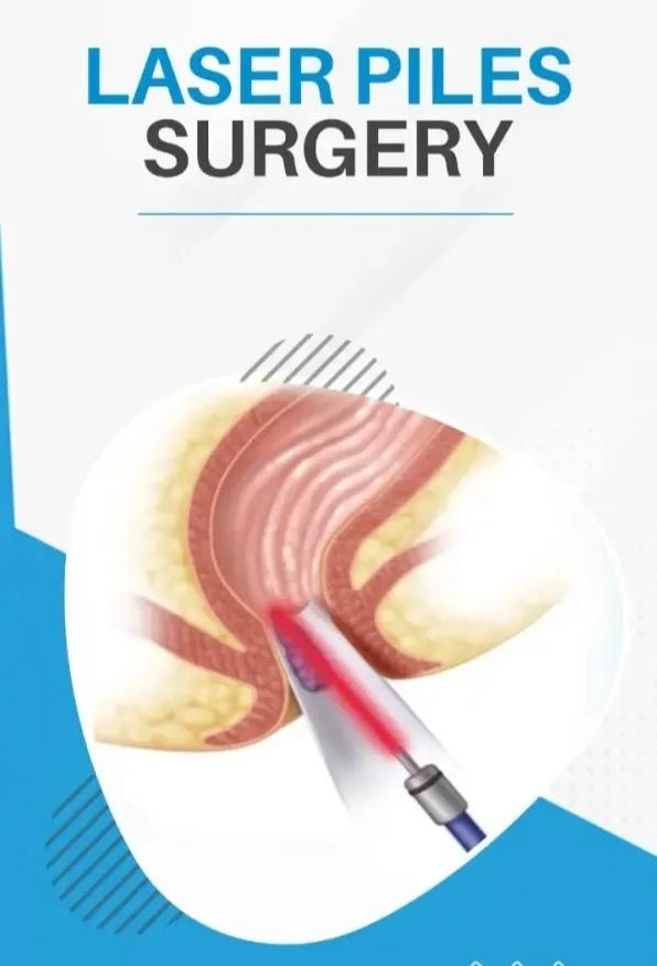 Laser Piles Surgery image 1