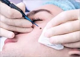ADVANCED ELECTROLYSIS FOR MILIA AND WARTS image 1