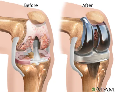 Revision Knee Joint Replacement Surgery image 1