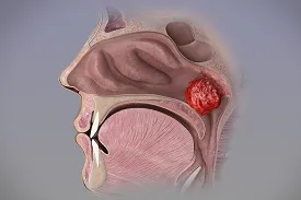 Adenoids Treatment image 1