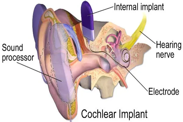 Cochlear Implant image 1