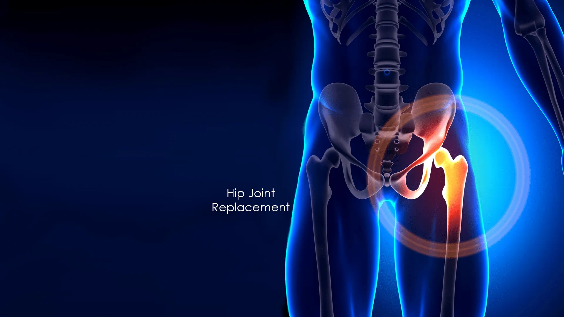 Hip Replacement image 1