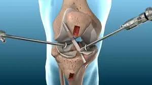 Ligament Reconstruction  image 1