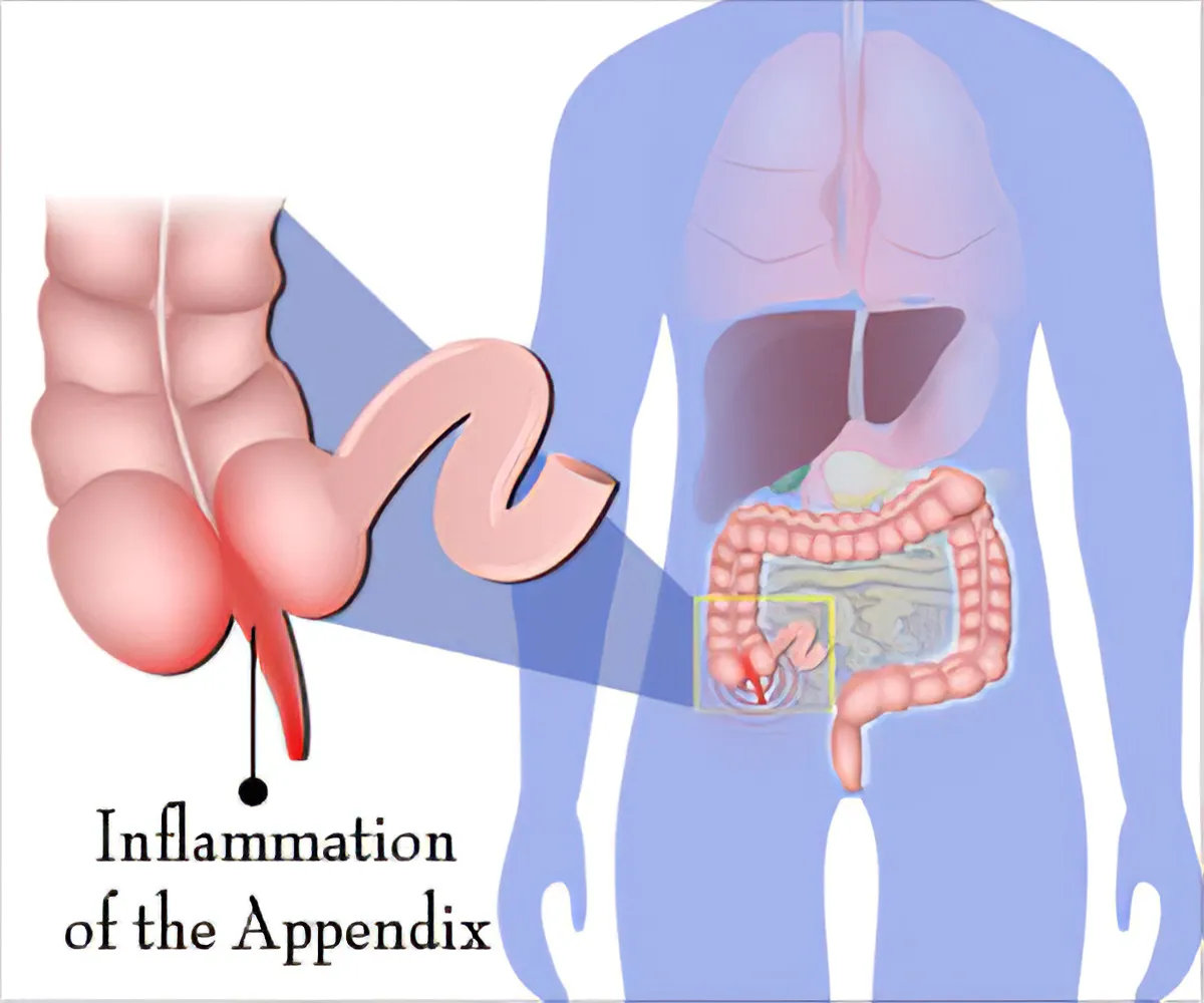 Appendix Treatment Doctor in Viman Nagar, Kharadi, Vishrantwadi, Pune image 1