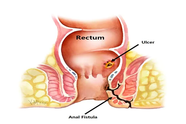 Fistula Treatment Doctor in Viman Nagar, Kharadi, Vishrantwadi, Pune image 1