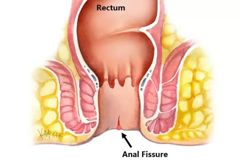 Anal Fissure Treatment Doctor in Viman Nagar, Kharadi, Vishrantwadi, Pune image 1
