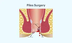 Laser Piles Surgeon in Viman Nagar, Kharadi, Vishrantwadi, Pune image 1