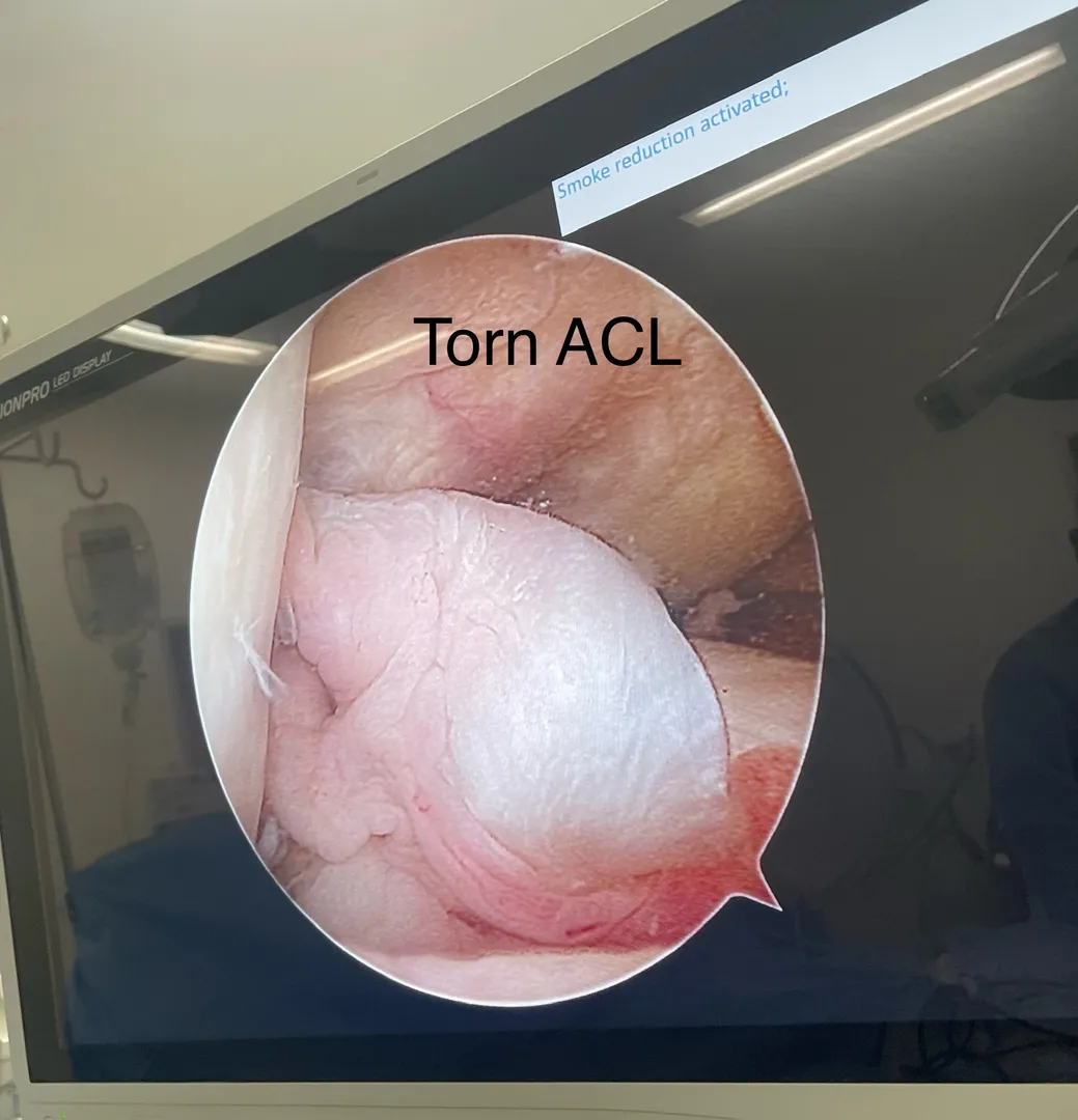 Arthroscopic ACL Reconstruction surgery image 1