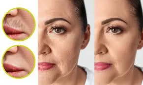 IPL Anti Aging Facial image 1