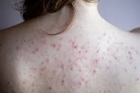 Back acne treatment image 1