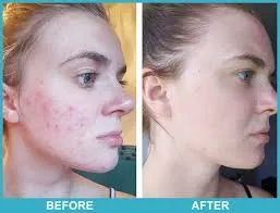 Back acne treatment image 2
