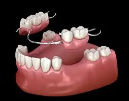 Replacement of Missing Teeth (Complete & Partial Dentures) image 1