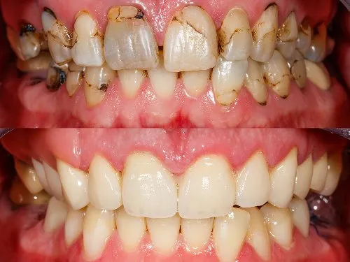 Full Mouth Rehabilitation image 1