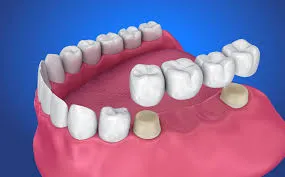Fixed Teeth (Crowns & Bridges) image 1