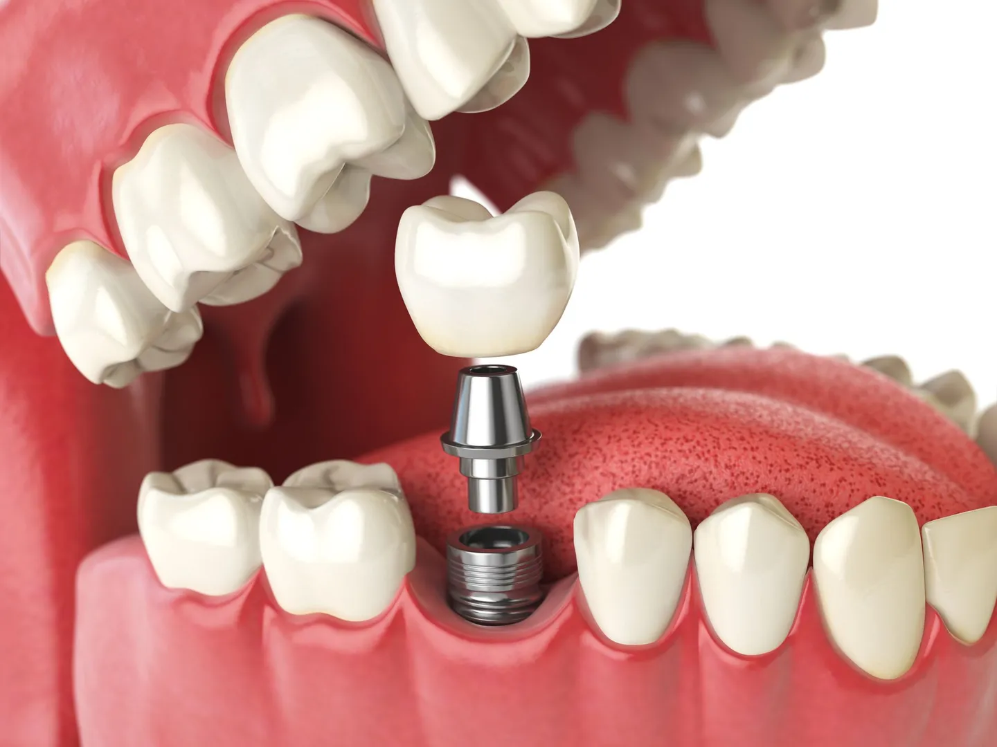 Dental Implants image 1