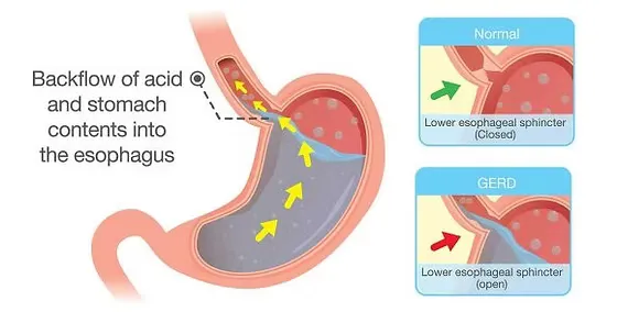 Gastroesophageal Reflux Disease (GERD) image 1