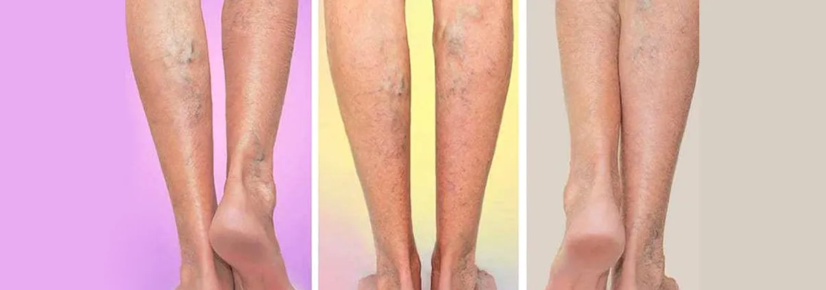 Varicose Veins image 1