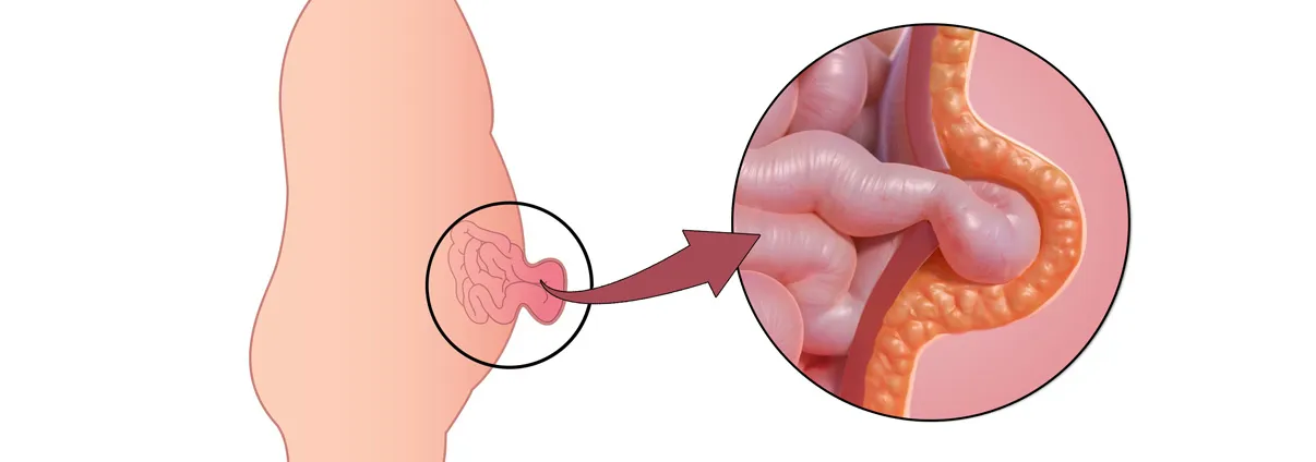 Hernia Surgery image 1