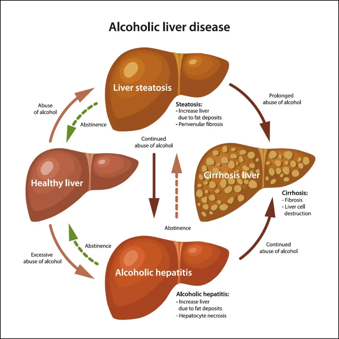 Alcoholic Liver Disease Specialist in Pune, PCMC, Maharashtra  image 1