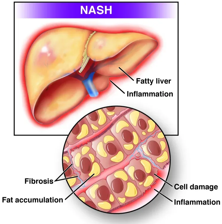 Non Alcoholic Steatohepatitis Treatment Specialist in Pune, PCMC, Maharashtra  image 1